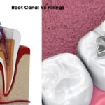 what do cavity fillings look like