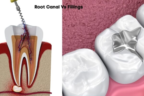 what do cavity fillings look like