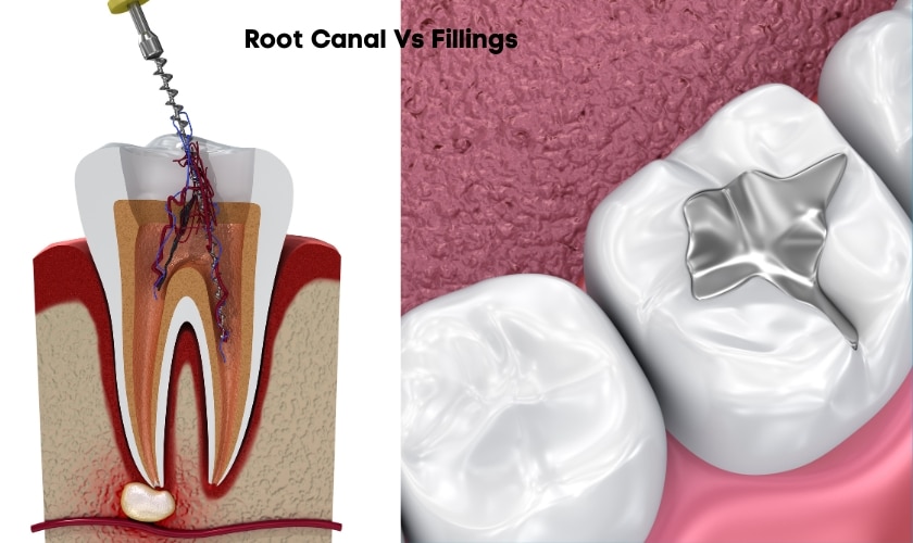 what do cavity fillings look like